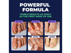 Orivelle Antifungal Pen