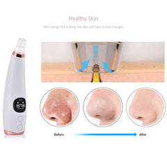 Black Head Remover Acne Cleansing High-pressure Suction - The Shopsite